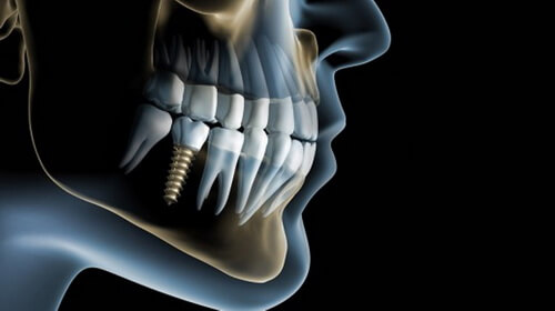 dental montenegro implantologija